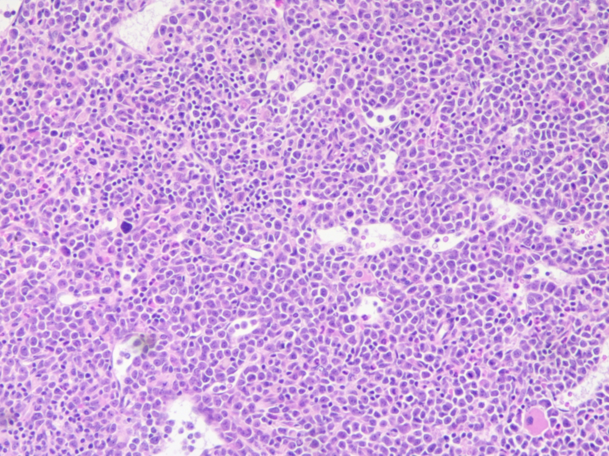 Bone marrow biopsy 10x